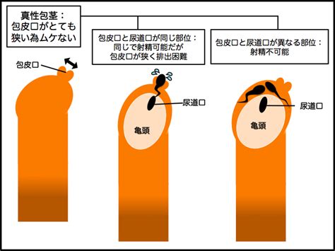 ほうけい 種類|包茎の種類【真性・仮性・嵌頓】や原因・包茎のリス。